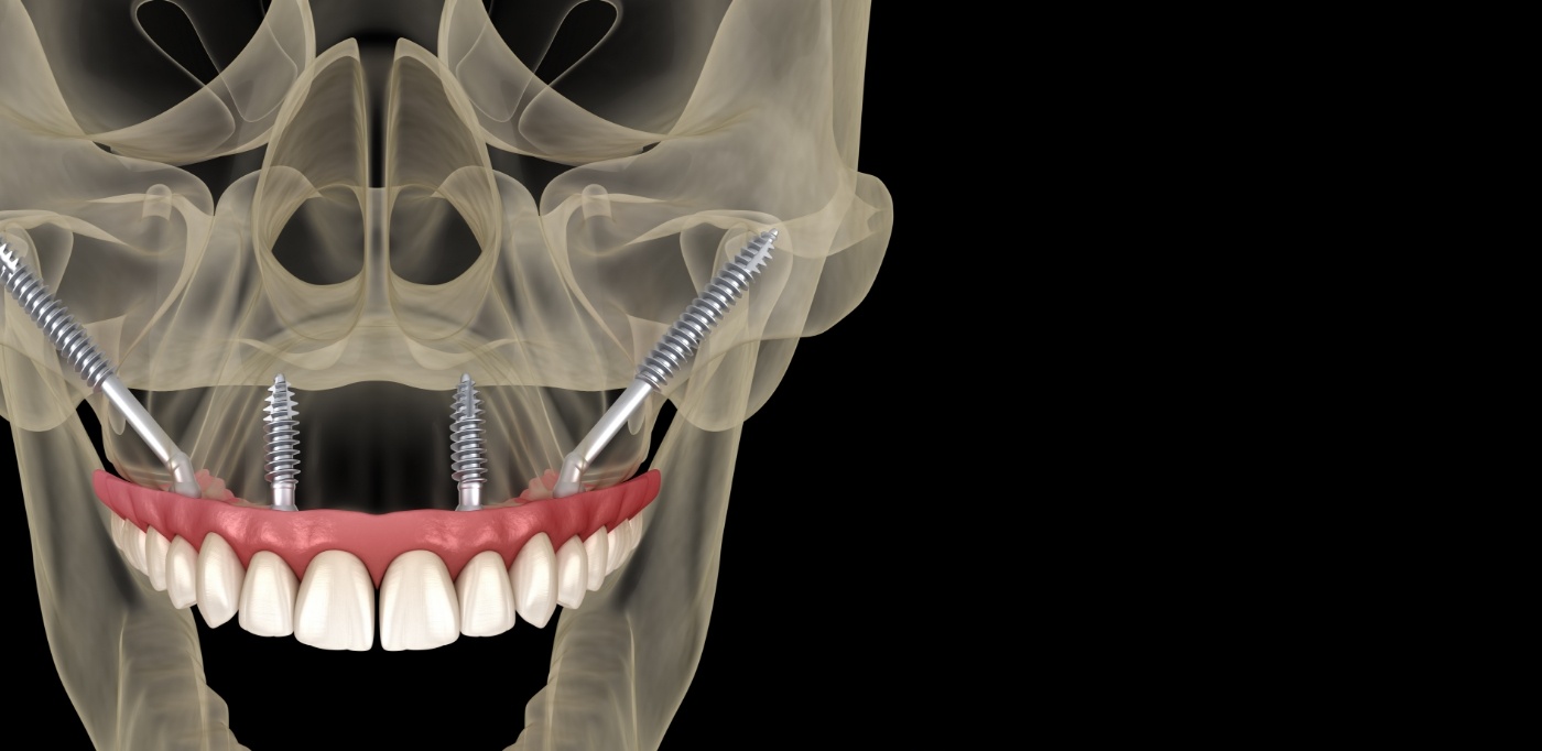 Illustrated x ray of a person with All on 4 dental implants replacing the upper arch of teeth