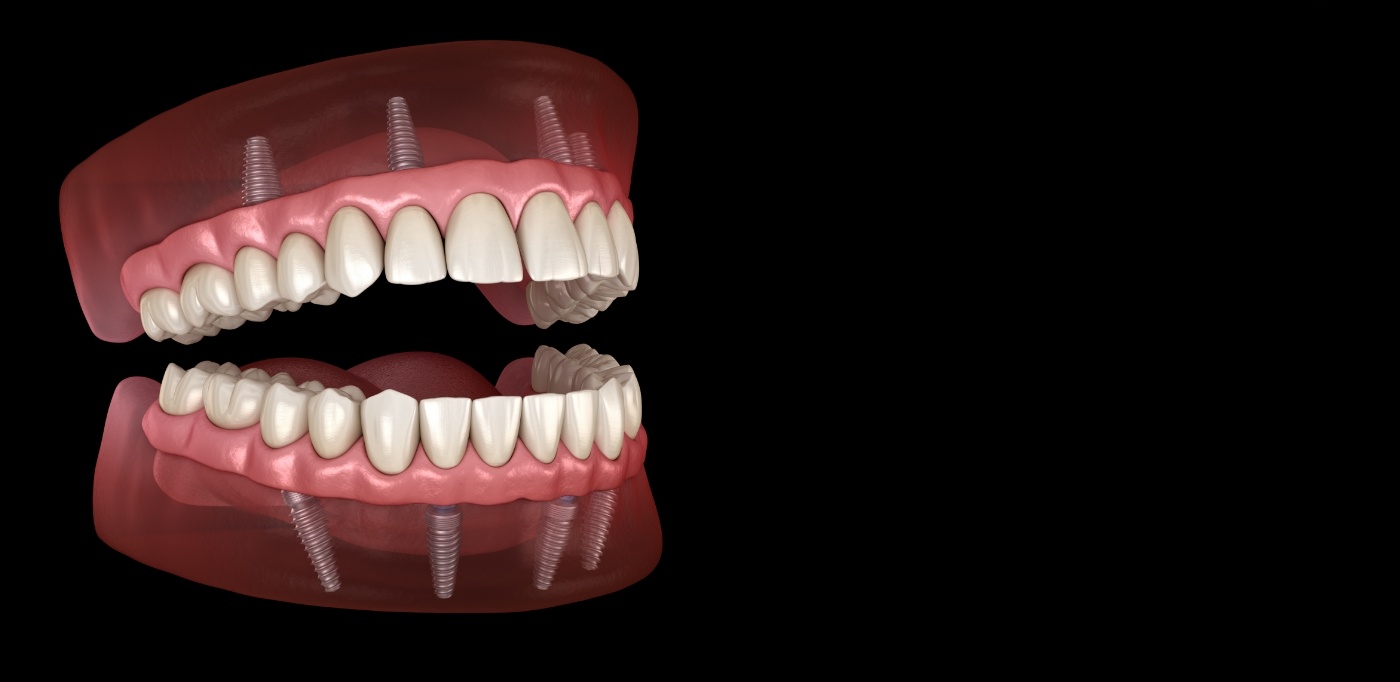 Illustration of All on 4 dental implants on both arches