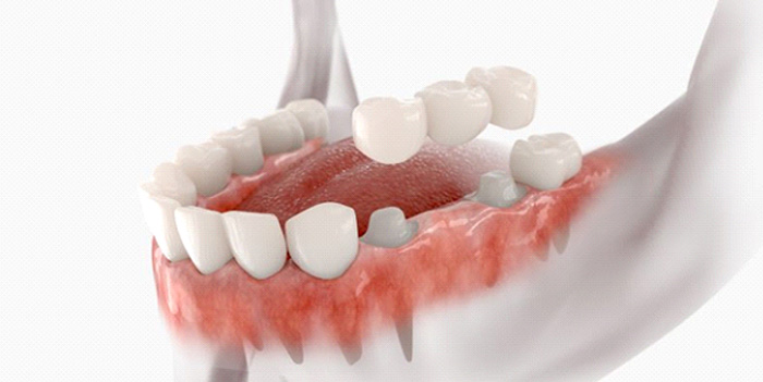 Dental bridge being attached to prepared teeth
