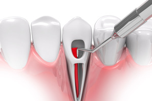 Do You Need a Root Canal Even If Your Tooth Doesn’t Hurt?