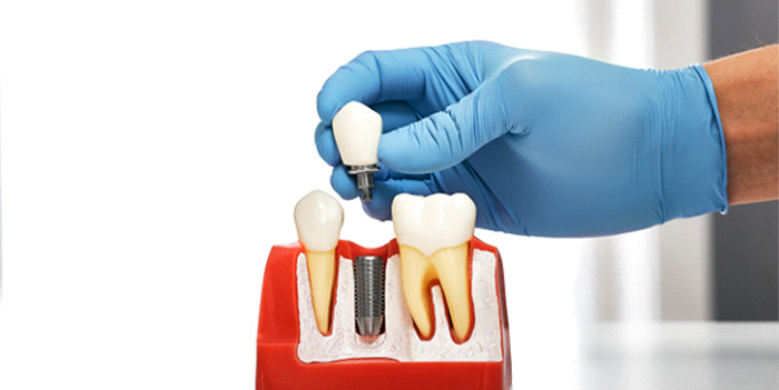 Your dental implants have several parts that could affect their price