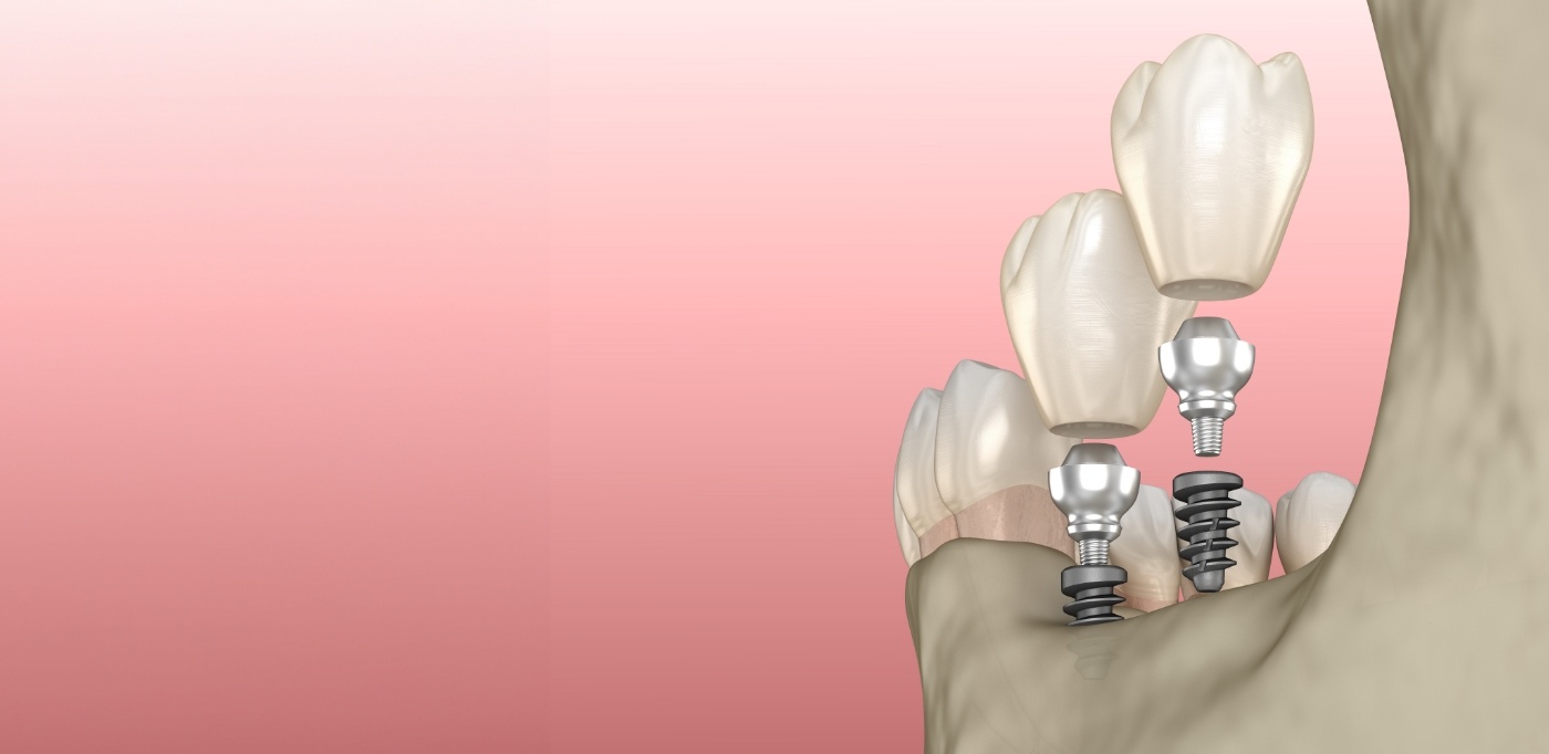 Illustration of two dental crowns being placed onto two mini dental implants in Baytown