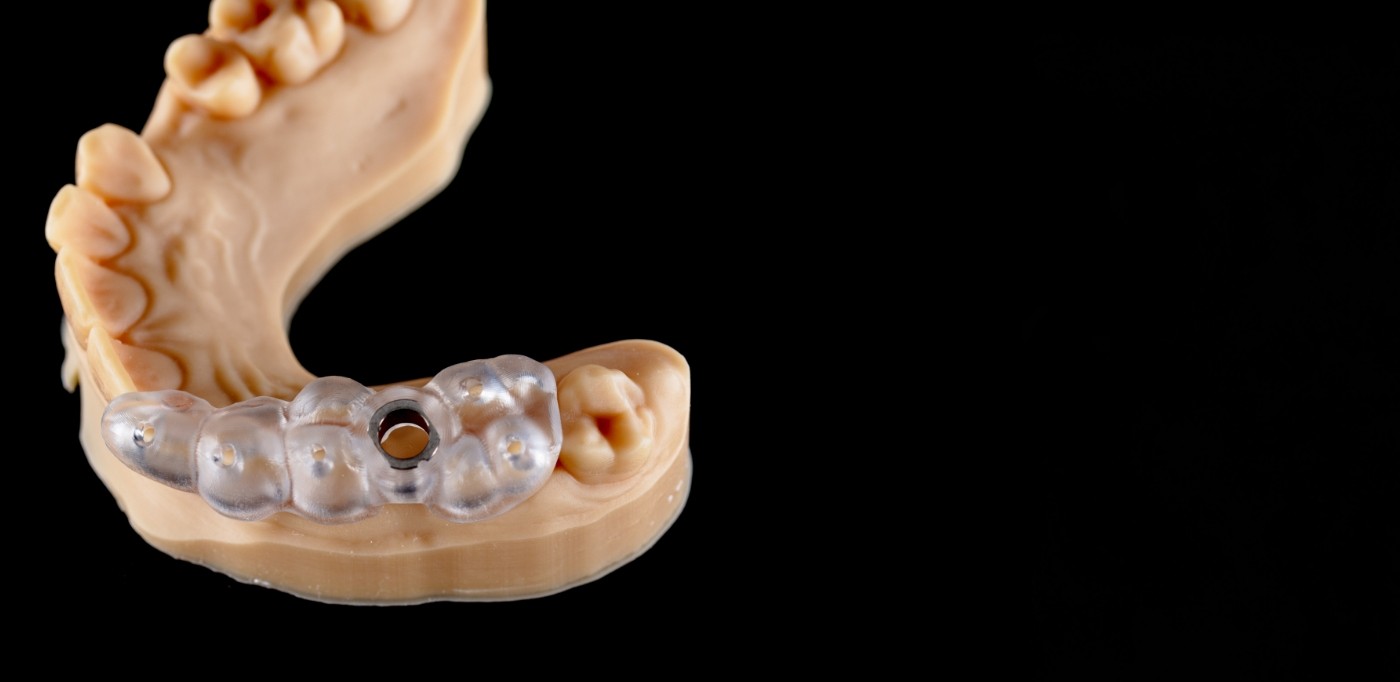 Model of the arch of teeth with a surgical guide for dental implant placement