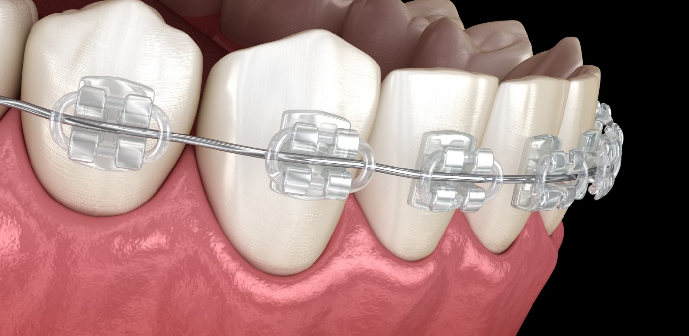 Illustration of row of teeth with braces with clear brackets